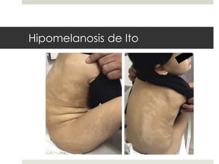Hipomelanosis de Ito
 