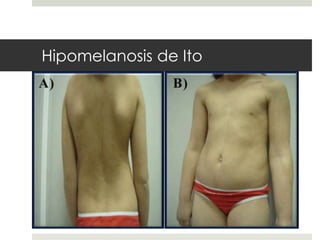 Hipomelanosis de Ito
 