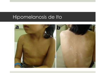 Hipomelanosis de Ito
 