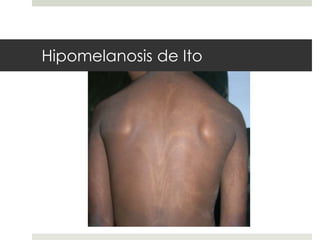 Hipomelanosis de Ito
 