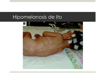 Hipomelanosis de Ito
 