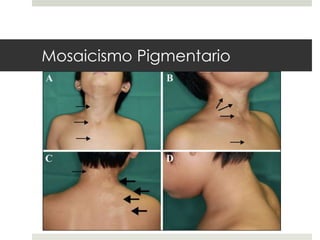 Mosaicismo Pigmentario
 