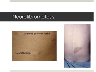 Neurofibromatosis
 