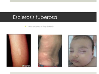 Esclerosis tuberosa
 Nevo acrcrómico en “hoja de fresno”
 