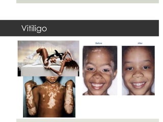 Vitiligo
 