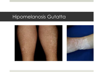 Hipomelanosis Gutatta
 