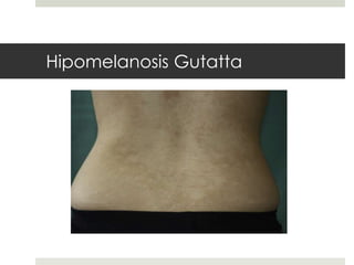 Hipomelanosis Gutatta
 