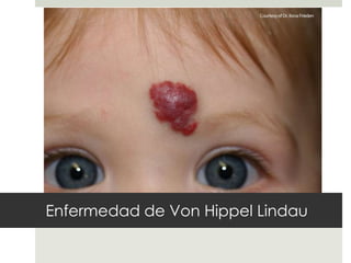 Enfermedad de Von Hippel Lindau
 