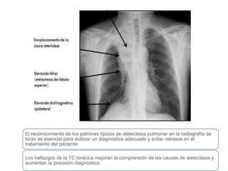 El reconocimiento de los patrones típicos de atelectasia pulmonar en la radiografía de
tórax es esencial para realizar un diagnóstico adecuado y evitar retrasos en el
tratamiento del paciente.
Los hallazgos de la TC torácica mejoran la comprensión de las causas de atelectasia y
aumentan la precisión diagnóstica.
 