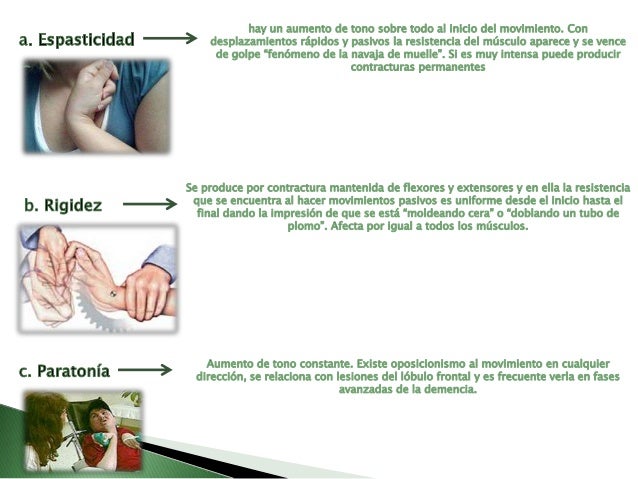 Sindrome piramidal