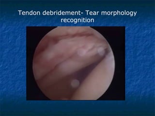 Tendon debridement- Tear morphology
recognition
 