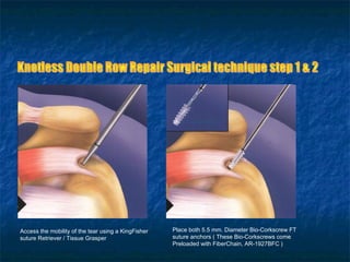 Access the mobility of the tear using a KingFisher
suture Retriever / Tissue Grasper
Place both 5.5 mm. Diameter Bio-Corkscrew FT
suture anchors ( These Bio-Corkscrews come
Preloaded with FiberChain, AR-1927BFC )
AR-1927BFC
 