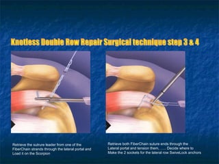 Retrieve the sutrure leader from one of the
FiberChain strands through the lateral portal and
Load it on the Scorpion
Retrieve both FiberChain suture ends through the
Lateral portal and tension them, ….. Decide where to
Make the 2 sockets for the lateral row SwiveLock anchors
 