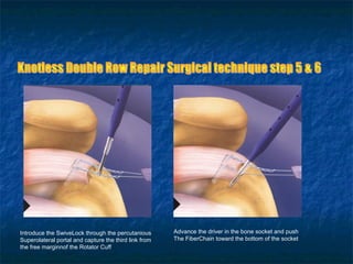 Introduce the SwiveLock through the percutanious
Superolateral portal and capture the third link from
the free marginnof the Rotator Cuff
Advance the driver in the bone socket and push
The FiberChain toward the bottom of the socket
 