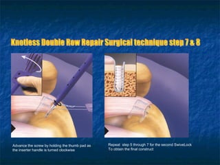 Advance the screw by holding the thumb pad as
the inserter handle is turned clockwise
Repeat step 5 through 7 for the second SwiveLock
To obtain the final construct
 
