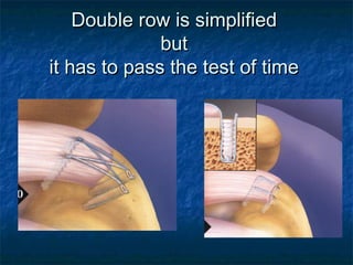 Double row is simplifiedDouble row is simplified
butbut
it has to pass the test of timeit has to pass the test of time
 