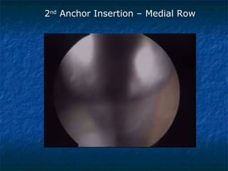 2nd
Anchor Insertion – Medial Row
 