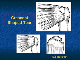 Crescent
Shaped Tear
S.S Burkhart
 