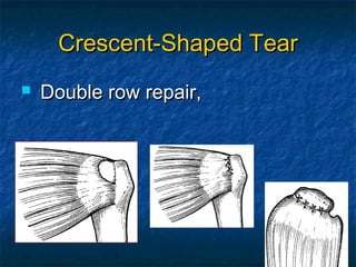 Crescent-Shaped TearCrescent-Shaped Tear
 Double row repair,Double row repair,
 