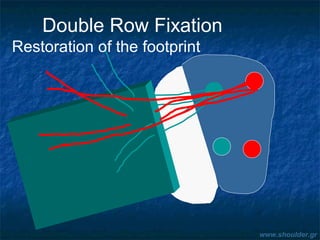 Double Row Fixation
Restoration of the footprint
www.shoulder.gr
 