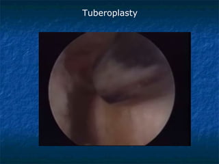 Tuberoplasty
 