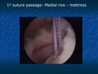 1st
suture passage- Medial row - mattress
 
