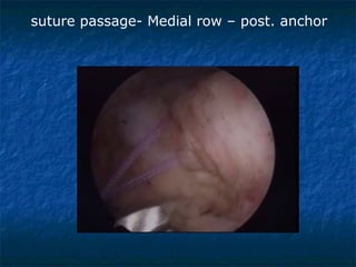 suture passage- Medial row – post. anchor
 