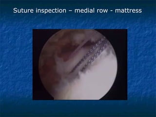 Suture inspection – medial row - mattress
 