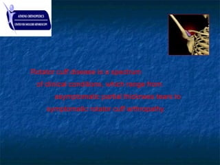 Rotator cuff disease is a spectrum
of clinical conditions, which range from
asymptomatic partial thickness tears to
symptomatic rotator cuff arthropathy
 