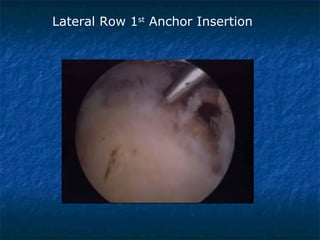 Lateral Row 1st
Anchor Insertion
 