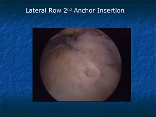 Lateral Row 2nd
Anchor Insertion
 