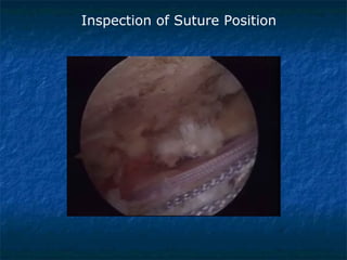 Inspection of Suture Position
 