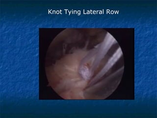 Knot Tying Lateral Row
 