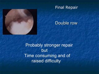 Final Repair
Double rowDouble row
Probably stronger repair
but
Time consuming and of
raised difficulty
 