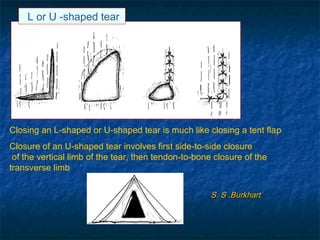 Closing an L-shaped or U-shaped tear is much like closing a tent flap
Closure of an U-shaped tear involves first side-to-side closure
of the vertical limb of the tear, then tendon-to-bone closure of the
transverse limb
L or U -shaped tear
S. S .BurkhartS. S .Burkhart
 