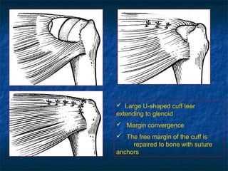  Large U-shaped cuff tear
extending to glenoid
 Margin convergence
 The free margin of the cuff is
repaired to bone with suture
anchors
 