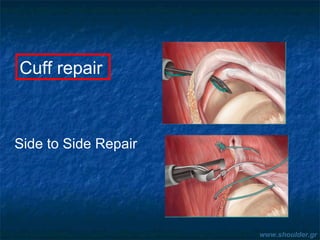 Side to Side Repair
Cuff repair
www.shoulder.gr
 