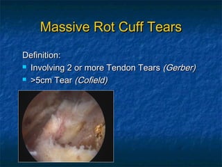 Massive Rot Cuff TearsMassive Rot Cuff Tears
Definition:Definition:
 Involving 2 or more Tendon TearsInvolving 2 or more Tendon Tears (Gerber)(Gerber)
 >5cm Tear>5cm Tear (Cofield)(Cofield)
 