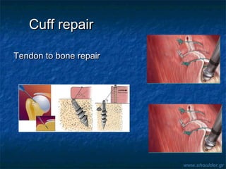 Cuff repairCuff repair
Tendon to bone repairTendon to bone repair
www.shoulder.gr
 