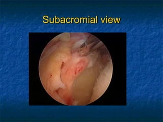 Subacromial viewSubacromial view
 