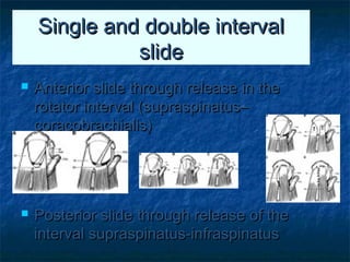 Single and double intervalSingle and double interval
slideslide
 Anterior slide through release in theAnterior slide through release in the
rotator interval (supraspinatus–rotator interval (supraspinatus–
coracobrachialis)coracobrachialis)
 Posterior slide through release of thePosterior slide through release of the
interval supraspinatus-infraspinatusinterval supraspinatus-infraspinatus
 