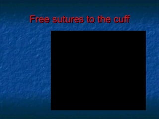 Free sutures to the cuffFree sutures to the cuff
 