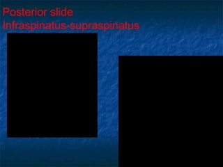 Posterior slide
Infraspinatus-supraspinatus
 