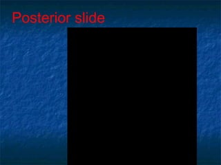 Posterior slide
 