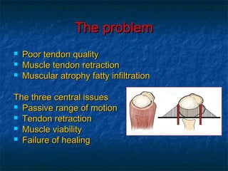 The problemThe problem
 Poor tendon qualityPoor tendon quality
 Muscle tendon retractionMuscle tendon retraction
 Muscular atrophy fatty infiltrationMuscular atrophy fatty infiltration
The three central issuesThe three central issues
 Passive range of motionPassive range of motion
 Tendon retractionTendon retraction
 Muscle viabilityMuscle viability
 Failure of healingFailure of healing
 