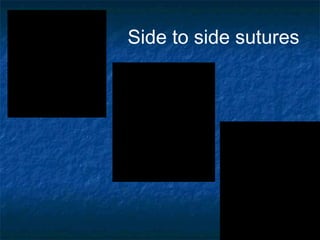 Side to side sutures
 