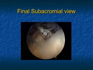 Final Subacromial viewFinal Subacromial view
 