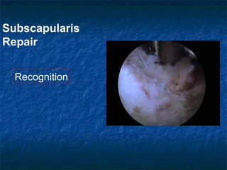 Subscapularis
Repair
Recognition
 