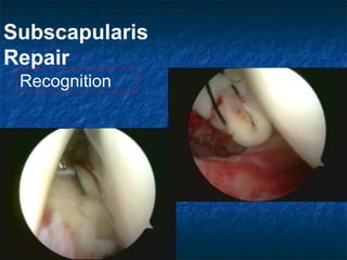 Subscapularis
Repair
Recognition
 