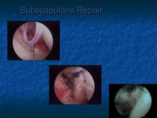Subscapularis RepairSubscapularis Repair
 